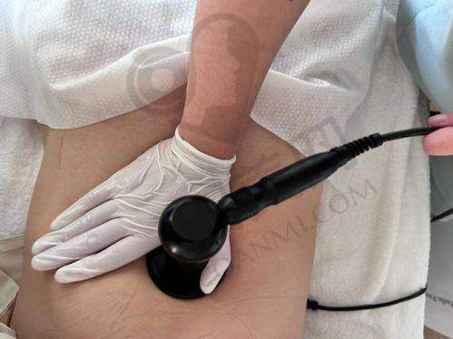 整形:丰富经验打造成功减脂实例