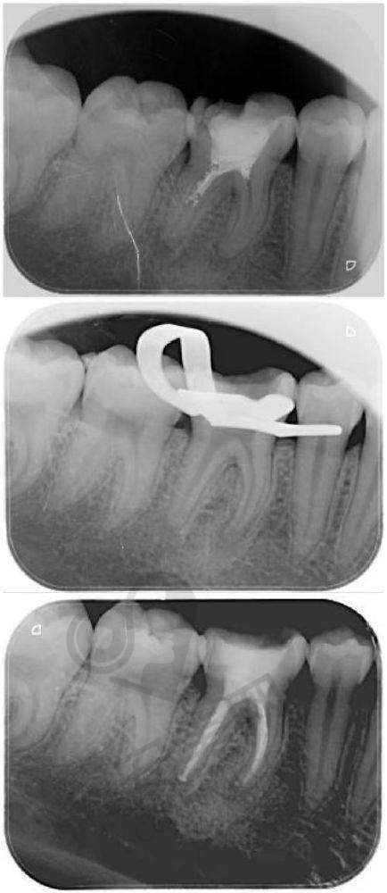 石家庄牙博士口腔医院牙齿根管治疗的过程痛苦吗?