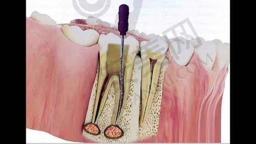 牙齿根管治疗后的成效和感受如何?