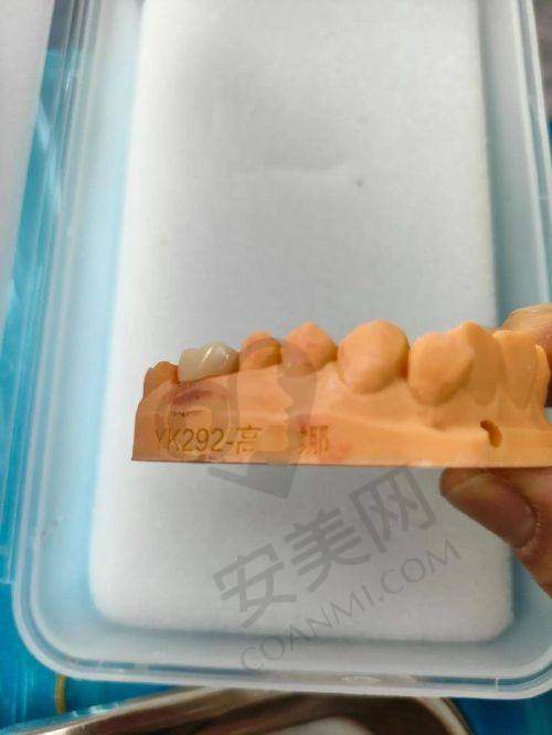 哪些人适合在淮安诺贝尔口腔医院选择爱尔创牙冠?