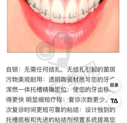 与其他品牌牙冠相比,爱尔创牙冠在淮安诺贝尔口腔医院有何不同?