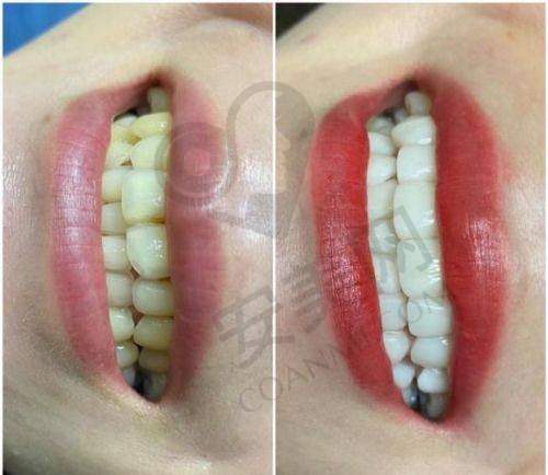 牙齿贴面美白后成效如何?有什么感受?