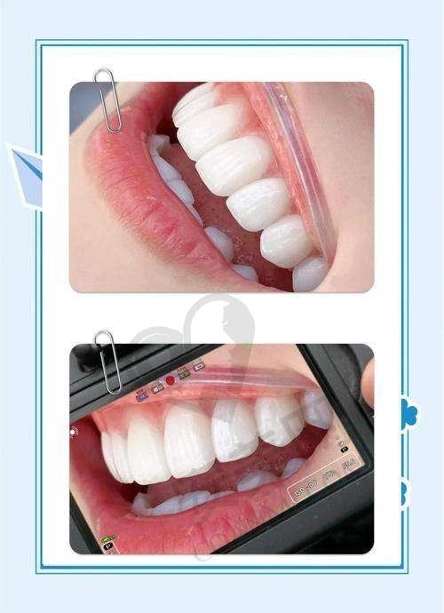 牙齿贴面美白的过程是怎样的?疼不疼?