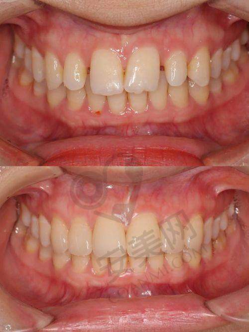 益阳德美口腔医院牙齿贴面美白技术有什么特色?