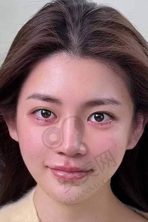 为什么选择济南海峡整形医院做热玛吉?