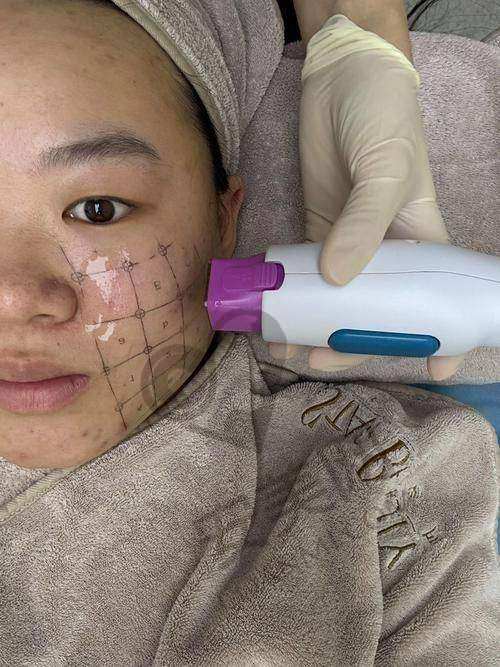 济南海峡整形医院热玛吉的成效如何?