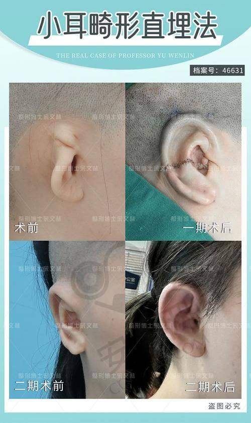 张正文小耳再造对比实例展示