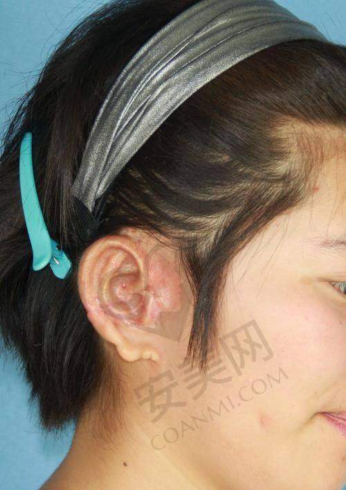 小耳畸形的现状与影响