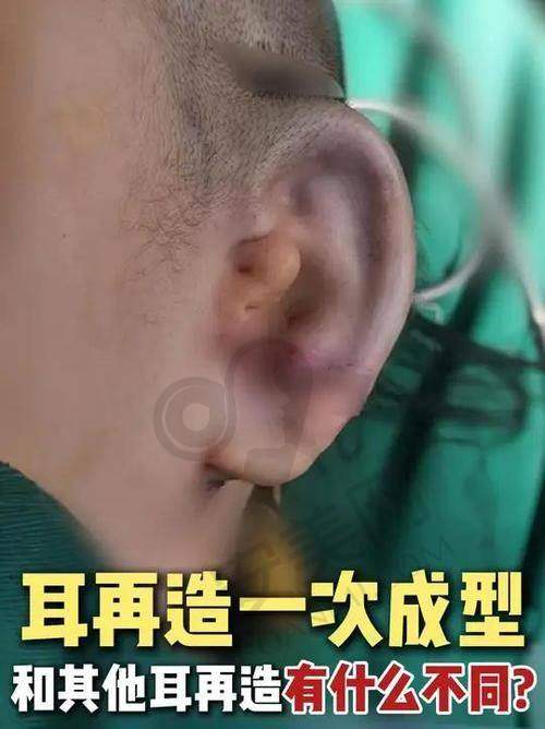 张正文小耳再造手术价格分析