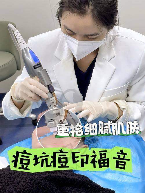 针体优化:细微改变带来巨大差异