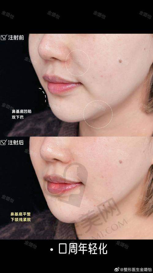 为什么选择重庆星荣郑胜院长的口周年轻化方案?