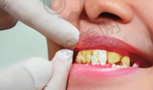 韩国登腾种植牙7500元起价格合理吗?