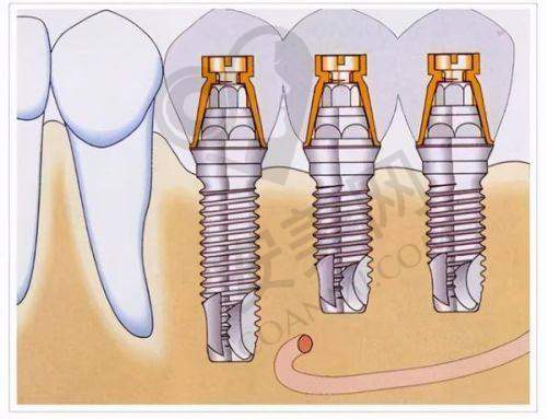 6、马鞍山鼎植口腔周路宽医生预约挂号指南