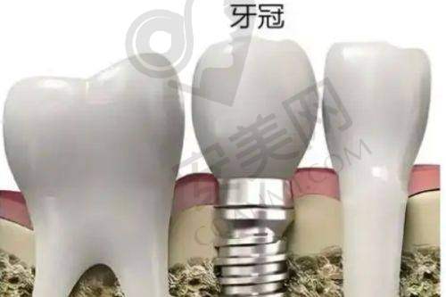 种植牙的过程是怎样的?