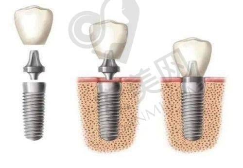 熊靖宇医生在种植牙领域有何优势?