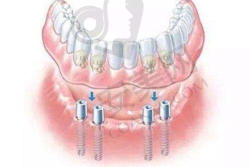 衢州蓝芽口腔其他热门项目收费如何?