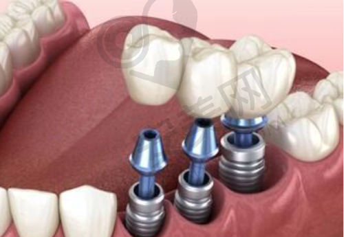 1、马鞍山鼎植口腔周路宽医生怎么样?
