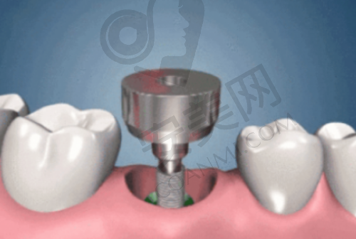 法国安卓健种植牙有什么优势?