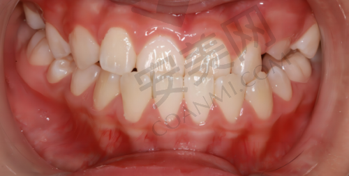 选择北京极简海德堡口腔做瑞典诺贝尔种植牙有哪些保护?