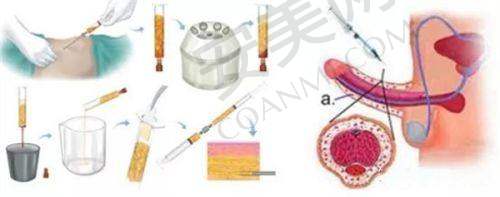 选择昆明艺星超声炮医生的注意事项有哪些?