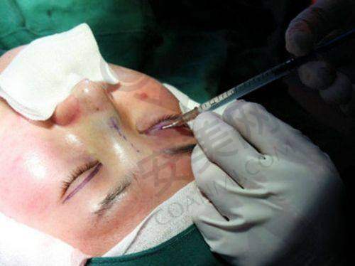 昆明艺星何瑞蛟口碑怎么样？众多成功眼整形案例见证卓越技术与良好口碑 