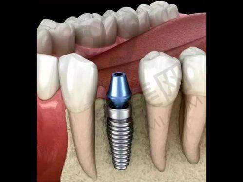 5、马鞍山鼎植口腔周路宽医生患者评价: