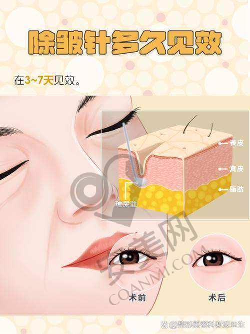 北京星灿宫医疗美容的除皱针有什么优势?