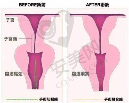 紧肤提升项目的注意事项
