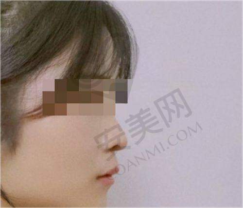 薛克墘医生在假体隆胸方面有哪些优势?