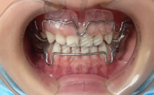 牙齿贴面美白是什么?