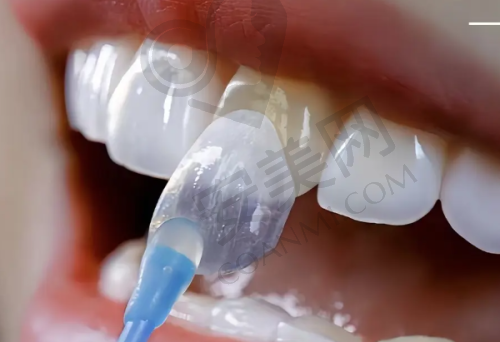 厦门麦芽口腔医院牙齿贴面美白的成效如何?