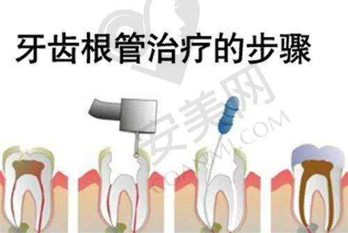 患者在根管治疗前后需要注意什么?