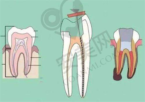 什么是根管治疗?