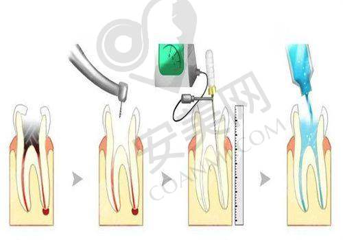 690元起的根管治疗价格是怎么回事?