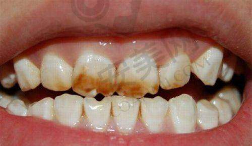 厦门麦芽口腔医院牙齿贴面美白的流程是怎样的?