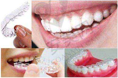 瑞典诺贝尔cc种植牙5900元起的价格是否合理？