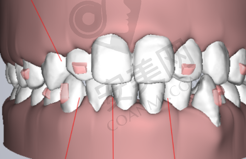 厦门麦芽口腔医院牙齿贴面美白1W元起8颗的价格贵吗?