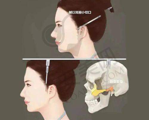 假体隆胸有哪些常见的疑问?