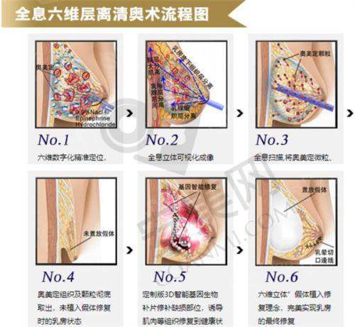 福州海峡医院薛克墘医生假体隆胸的成功实例多吗?