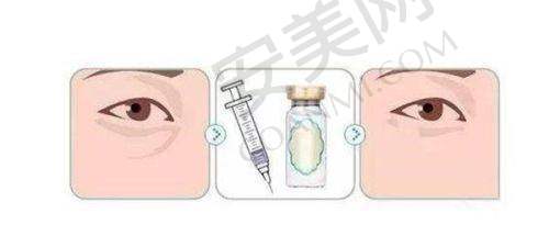 福州海峡医院在假体隆胸方面有什么特色?