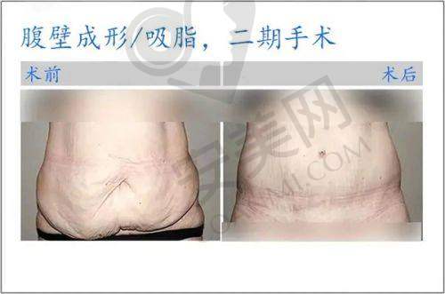 自体脂肪隆胸:安心又自然的美胸选择