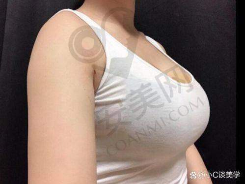 重庆军美章小平医生操刀自体脂肪隆胸,仅30000元起开启美胸新体验!