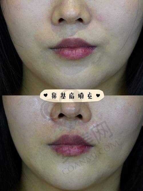 长沙美莱吴姗姗医生注射玻尿酸填充鼻基底价格详情