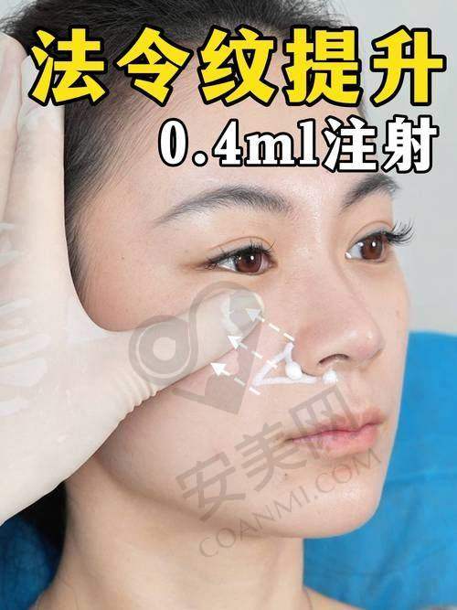 长沙美莱吴姗姗医生注射玻尿酸填充鼻基底,仅需3980元起焕美新生!