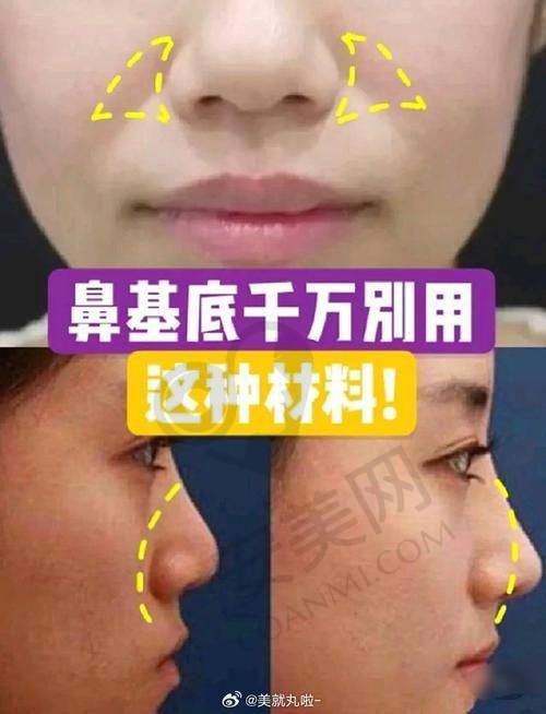 玻尿酸填充鼻基底的优势有哪些?